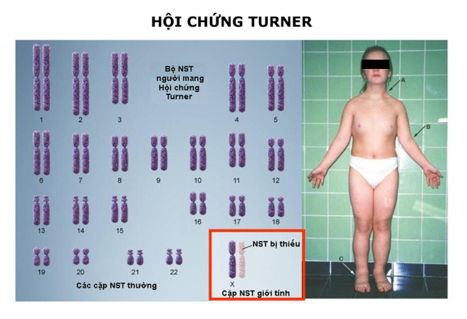 Bất thường bộ nhiễm sắc thể XO (hội chứng Turner) gây dậy thì muộn